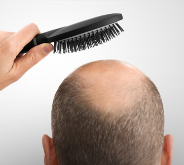 hair loss treatment in chennai